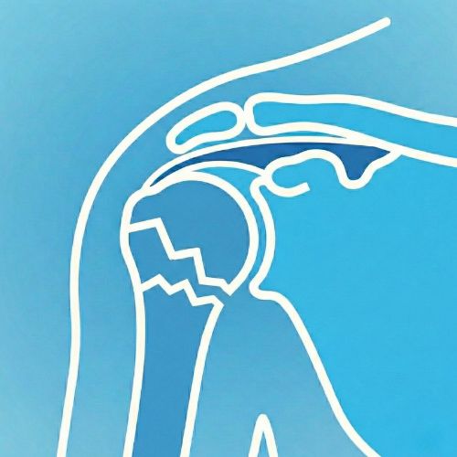 Diagramma anatomico essenziale di una spalla che mostra una linea di frattura a zigzag nettamente visibile sulla testa dell'omero (l'osso del braccio), indicando una rottura ossea.