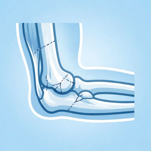 Schema anatomico del gomito che mostra diverse linee di frattura tratteggiate sull'estremità inferiore dell'omero e sulla testa del radio, indicando possibili punti di rottura ossea.