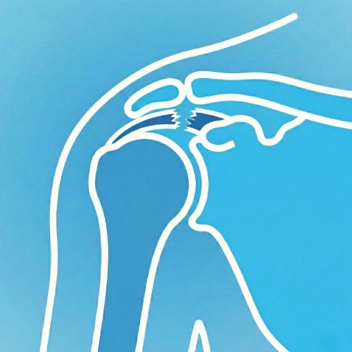 Grafica medica di una spalla in cui il tendine superiore che collega il muscolo all'osso appare sfilacciato e interrotto al centro, rappresentando una lacerazione o lesione dei tendini della cuffia dei rotatori.