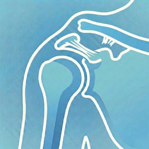 Diagramma stilizzato di una lussazione acromion-claveare della spalla, che mostra la separazione tra clavicola e scapola.