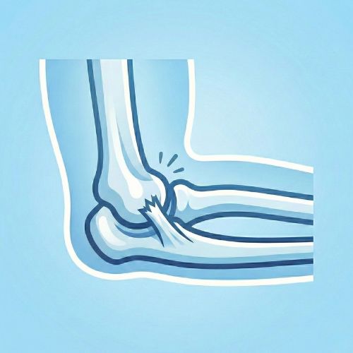 Rappresentazione schematica di una lussazione del gomito, con l'omero e le ossa dell'avambraccio visibilmente disallineati e fuori sede, accompagnati da una lacerazione dei legamenti.