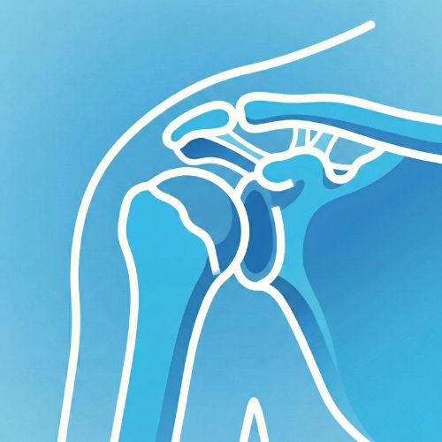 Illustrazione di un'articolazione della spalla dove la testa dell'omero è completamente fuoriuscita dalla sua sede naturale (la cavità glenoidea), mostrando graficamente la perdita di contatto tra le superfici articolari.