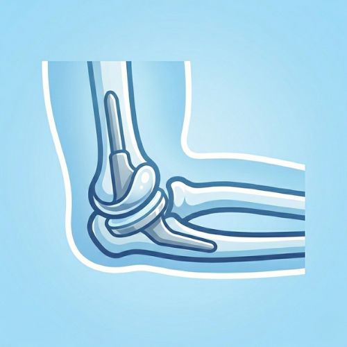 Illustrazione medica di un'articolazione del gomito che mostra l'inserimento di una protesi artificiale metallica all'interno dell'omero e dell'ulna per ripristinare la funzionalità articolare.